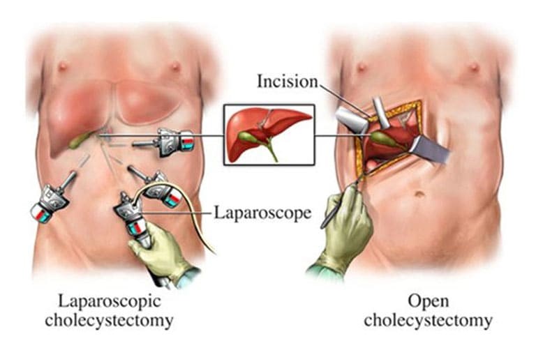 Gallbladder Surgery