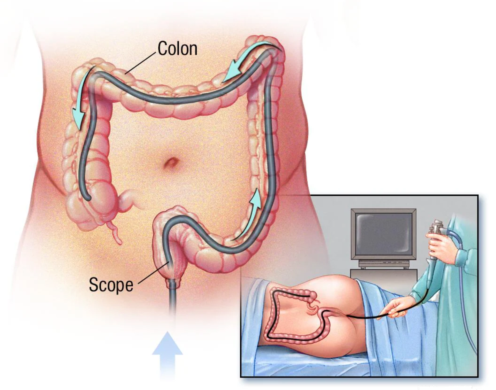 Colonoscopy