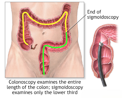 sigmoidoscopy