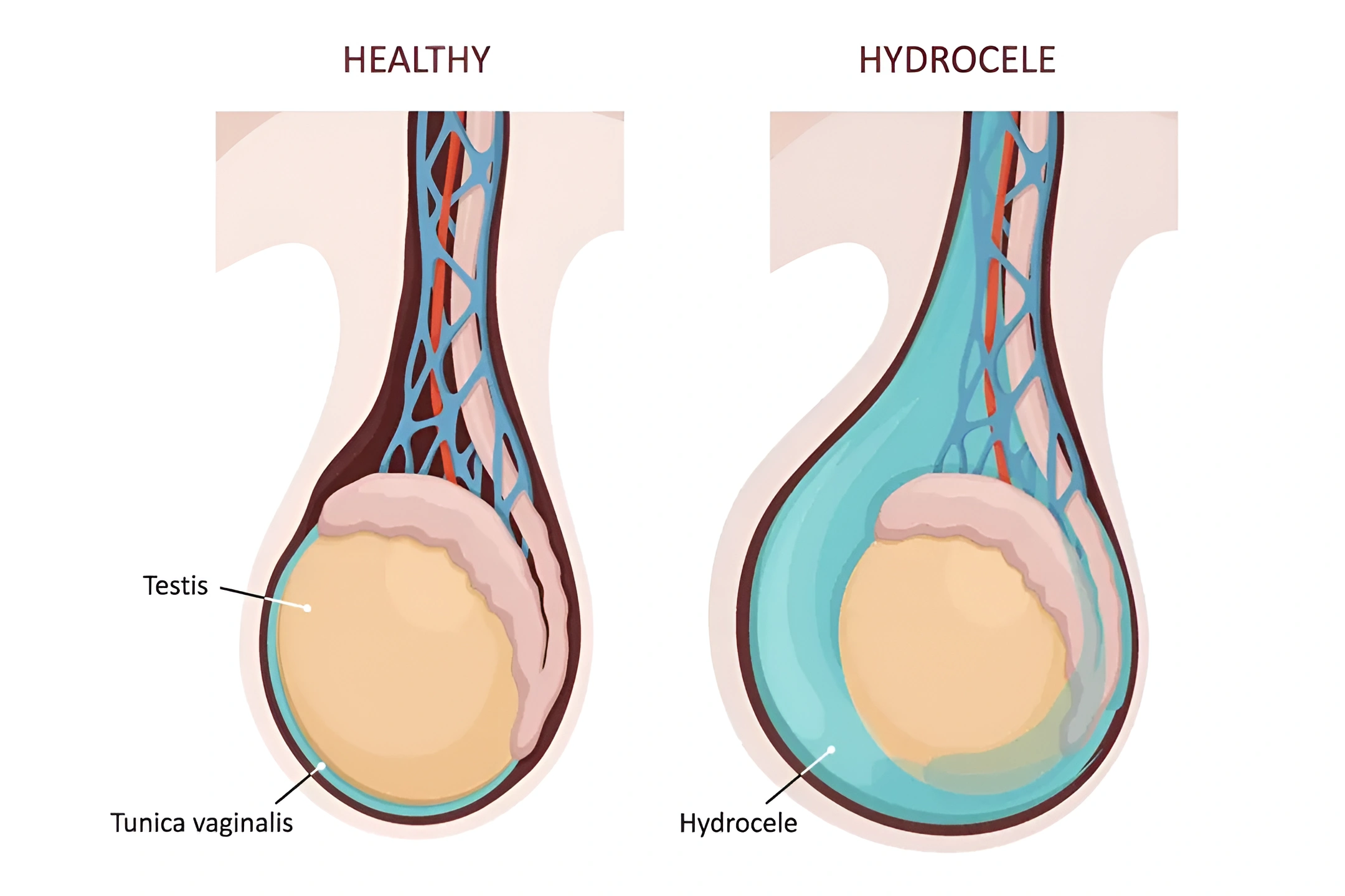 Hydrocele