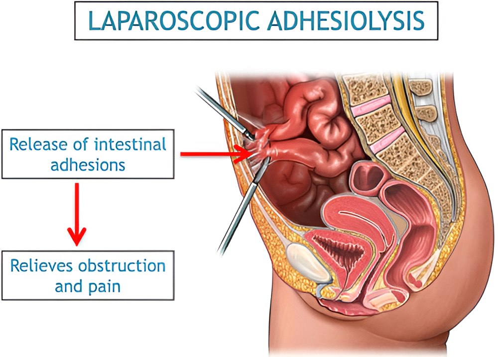 Adhesions