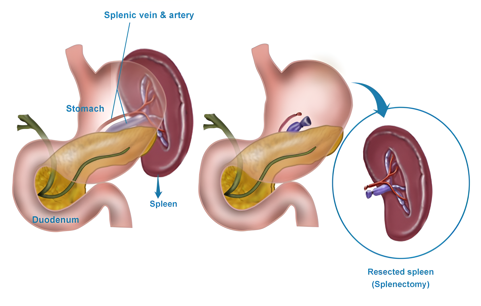Splenectomy