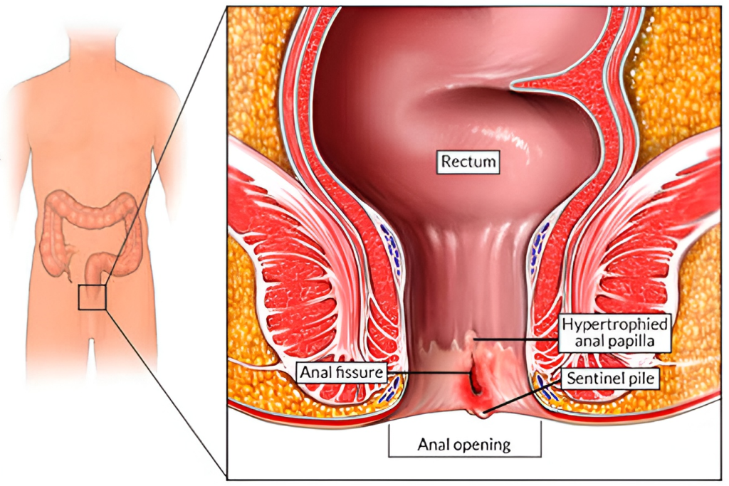 Fissurectomy