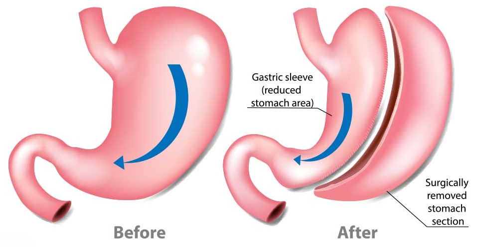 Gastrectomy