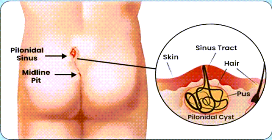 Pilonidal Sinus