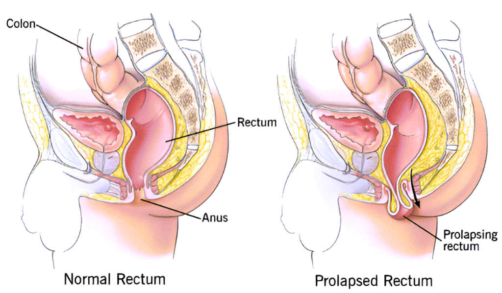 Rectal Prolapse