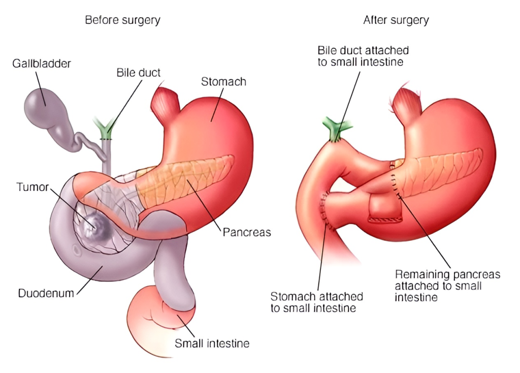 pancreatic surgery